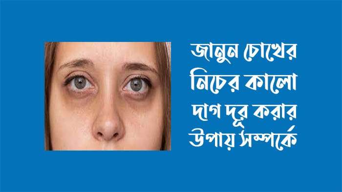 চোখের নিচে কালো দাগ দূর করার উপায়